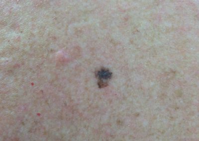 BSC Clinical Pic 107