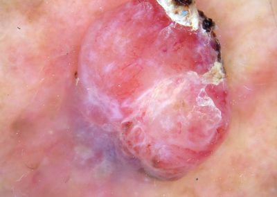 BSC Clinical Pic 108