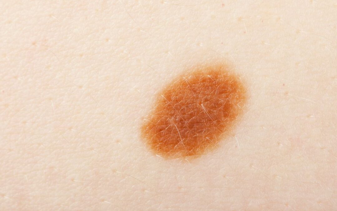 Protected: Beyond Sunburn: Hidden Risk Factors for Skin Cancer in Queenslanders